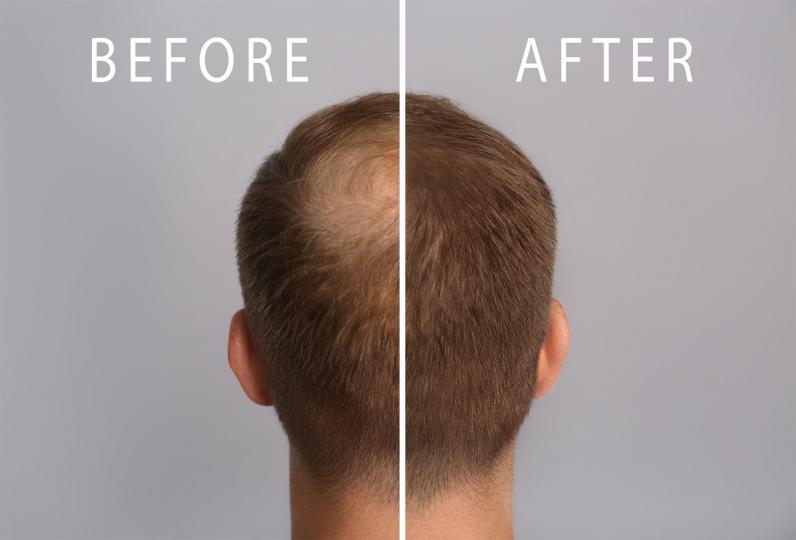 PRP Before & After for hair loss